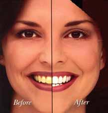 Teeth Whitening